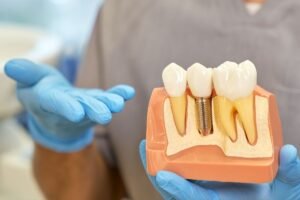 Dental Implants